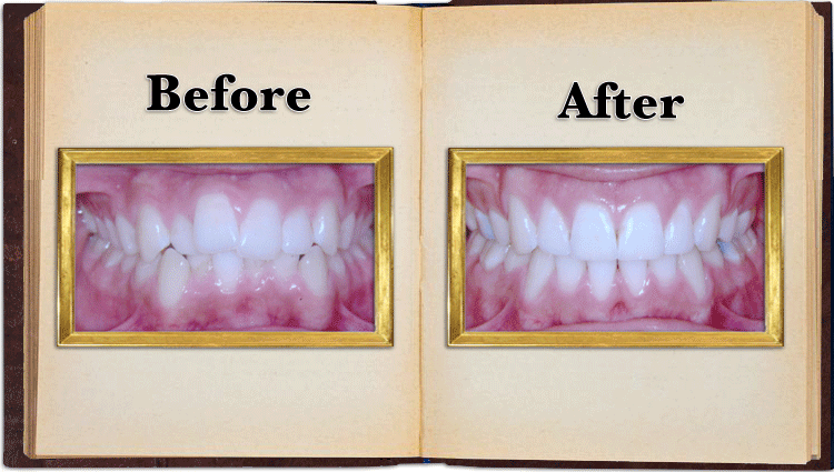 Crowded Teeth Before and after